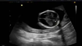Echographie 15 semaines