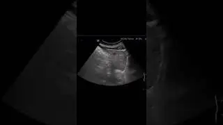 simple liver cyst ✨