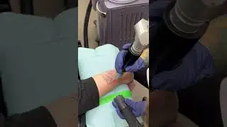 RevLite Si Laser Tattoo Removal - Hand + Geo lines b/o arm #lasertattooremoval #cynosure #laser