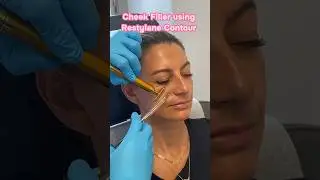 Restylane Contour helps to support and contour your cheeks! 💉 #restylane #fillers #contour #shorts