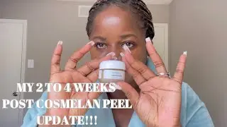 Cosmelan peel/Mask | 2-4 WEEKS POST APPLICATION UPDATE! Part 3 of 4