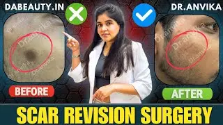 Successful Scar Transformation Journey ll Before After ll #dranvika #skincare #dermatologist 