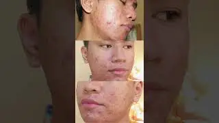 DERMA STAMP for Acne Scars