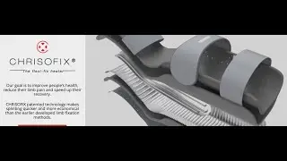 Introducing Chrisofix, a modular and customizable approach to splinting.