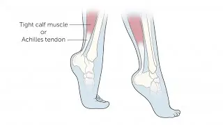 How to stop toe walking/ Causes/ Exercises at home 