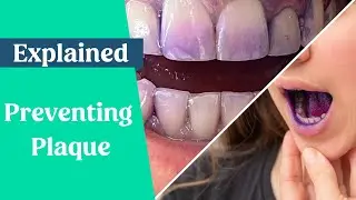 How to prevent/limit plaque build up
