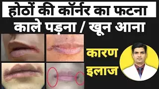 होठों के कार्नर का कालापन पड़ना | Angular cheilitis