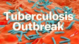 Tuberculosis Outbreak In Kansas Is The Largest In US History