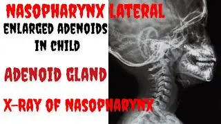 X-Ray of Nasopharynx Lateral view || Enlarged Adenoid Gland || Nasopharynx X-Ray Positioning ||