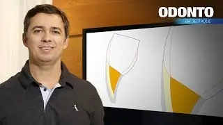 Como evitar que a transi&ccedil;&atilde;o da restaura&ccedil;&atilde;o com o dente fique aparente ap&oacute;s o acabamento?