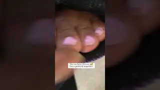 She was BORN with WEBBED toes! 🥰 #borndifferent #feet #shorts