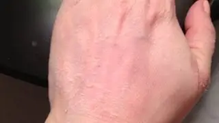 TCA Peel on Hands Results