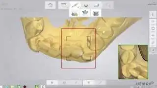 Impronta con scanner intraorale