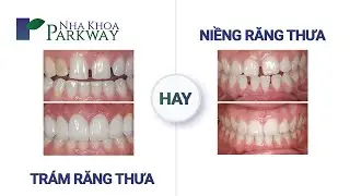 RĂNG THƯA NÊN TRÁM HAY NIỀNG | NIỀNG RĂNG A - Z