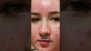 😳 Если на коже появилось ЭТО &mdash; немедленно к врачу! #новости