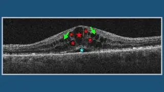 Intraretinal Fluid (IRF): Empty Cysts