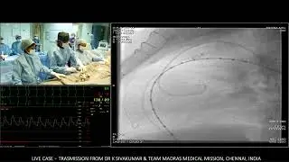 7/10 Percutaneous Pulmonary valve implantation (PPVI with Melody valve in stenosed Rastelli conduit