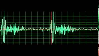 Mitral Regurgitation- normal speed