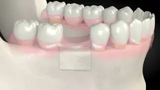 Bone Grafting Dental Centre Turkey Dental Centre Antalya Dental Hospital Turkey
