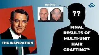 I Wanted My Youthful Hair Back | We Grow Hair Indy