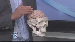 Ask a Specialist: Simple Ways to Prevent Stroke