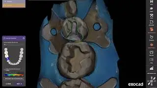 Real time  design for a quadrant case in exocad. Why use anything else?