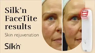 Silk'n FaceTite - Skin rejuvenation - Before and After
