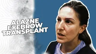 Transformative Women's Eyebrow Transplantation Journey | Achieving Natural Beauty!