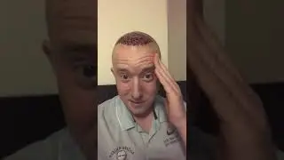 Hair Transplant Recovery & Aftercare Day 5