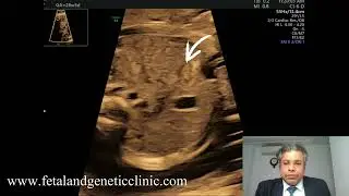 V-shaped Transverse Colon fixation - Mesenteric Band