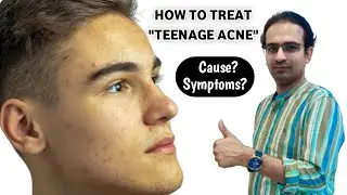 how to treat teenage acne | teenage acne treatment | teenage acne treatments that work #teenageacne