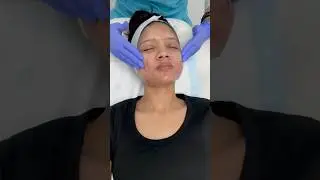 Chemical peel done. #acnetreatment #chemicalpeel #mandalicpeel #acnescars #acnechemicalpeel