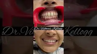 Laminate composite #restoration #smiledesign #shortvideo #dehradun #dentist #shorts #ytshorts #smile