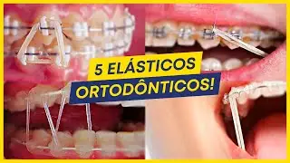 5 TIPOS de ELÁSTICOS MAIS COMUNS usados no APARELHO ORTODÔNTICO!