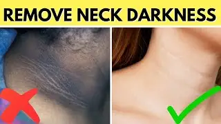 Remove Dark Neck Fast 😱| Ghar Pe 1 Din Me Gala Kaala Se Safed 🤯| 100% Natural Remedy!🚨