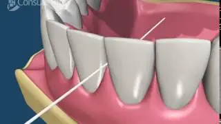 Flossing Technique | Dr Joy Dental Clinic - Dubai