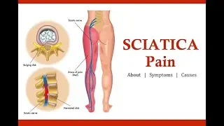 Sciatica Pain Treatment by TIENS suppliments and Therapy
