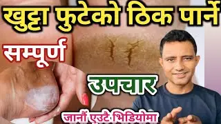 Treatment for foot crack ! खुट्टा फुटेको घरायसी तथा मेडिकल औषधि उपचार कसरी गर्ने जाऔं #swasthyatips