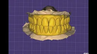 Upper & lower full arch designing in exocad