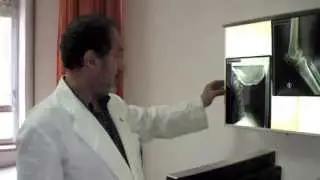 La Fibromialgia al descubierto.