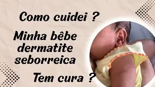 DERMATITE SEBOREICA| O QUE NINGUÉM FALA #dermatiteseborreica #bebes 