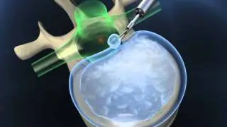 Full-endoscopic spinal surgery, transpedicular (transforaminal) approach
