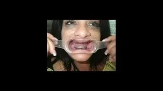 Why I have NO teeth | My 2nd Dental Experience in Mexico