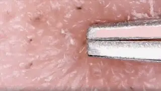 27 Million People Have Watched This Viral Blackhead Removal