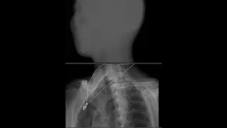 x-ray image enhancement algorithm