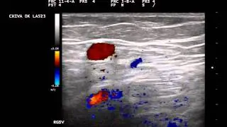 Dr. Delfrate Roberto Ecocolor Doppler Varici Sintomatiche Video: 7 Rientro Grande Safena