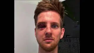 Michael Mosiman Injury Update 