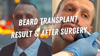 Beard Transplant Result | Beard Transplant Before and After #beardtransplant