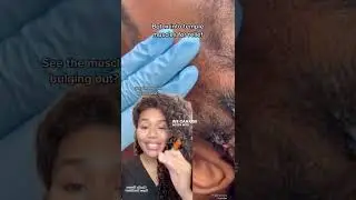 Botox for migraines, headaches, TMJ, clenching, teeth grinding, temporalis pain relief, head tension