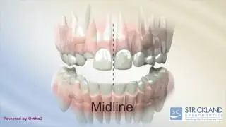 Midline Shift Due to Blocked Teeth SO